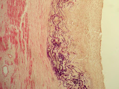 Calcificación metastásica (aorta bovino)