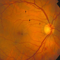 dot blot hemorrhages dot blot hemorrhages