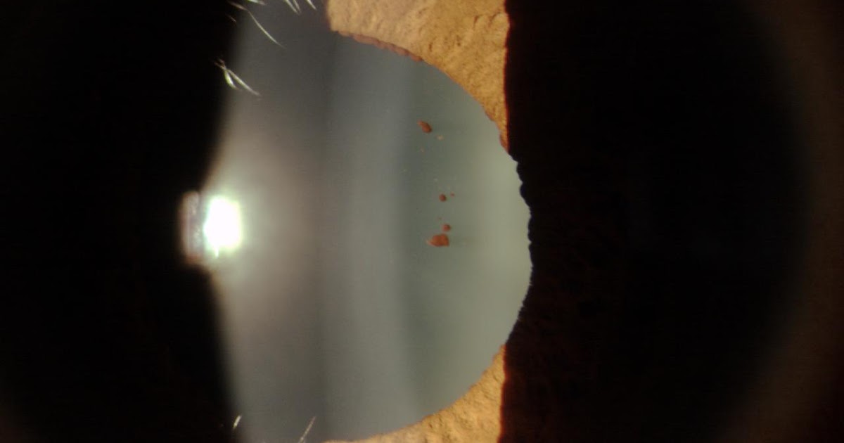 Sonoran Desert Eye Center PIGMENT ON ANTERIOR CAPSULE