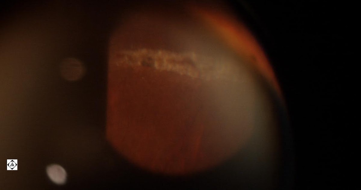 Sonoran Desert Eye Center SNAILTRACK DEGENERATION