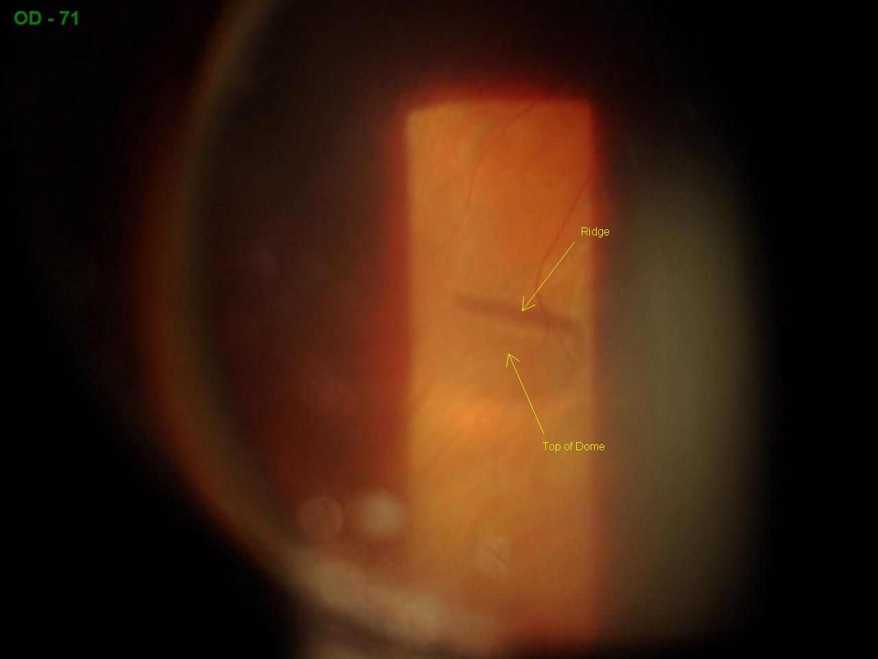 Sonoran Desert Eye Center UNUSUAL RETINOSCHISIS