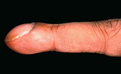 As the infection worsens, the nail bed may retract, and nails may thicken