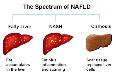treatment fatty liver