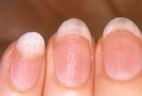 nagels met ribbels nagels met ribbels