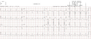 nstemi ekg