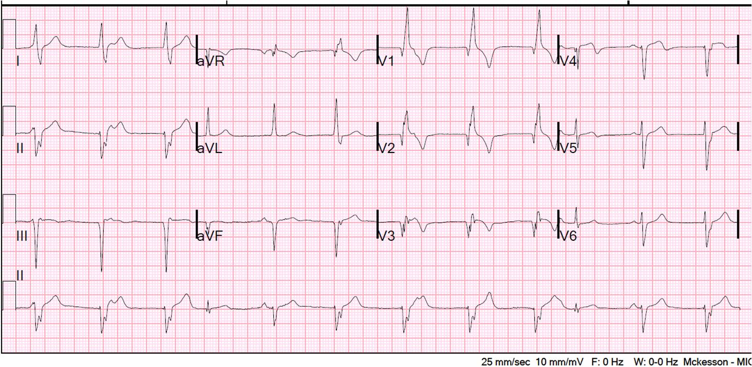 Abnormal Ekg Tracings