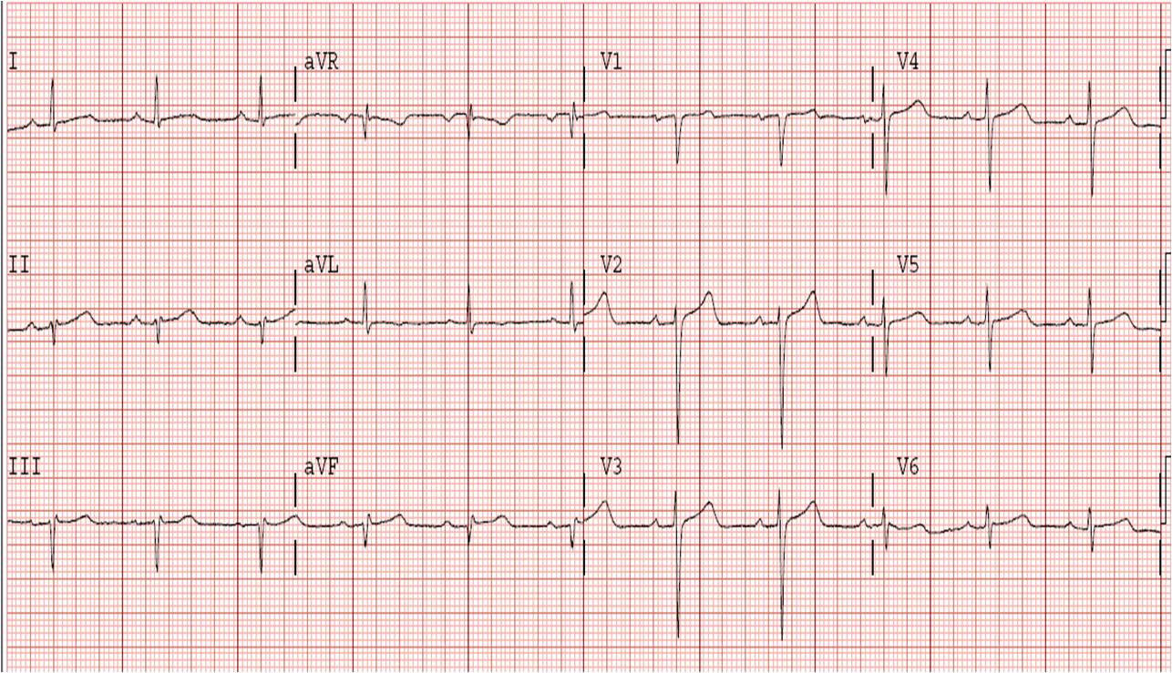 cardiogenic shock due to myocardial