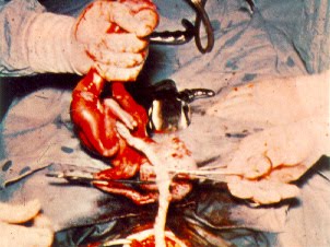 Aborto por Histerotomía u operación cesárea