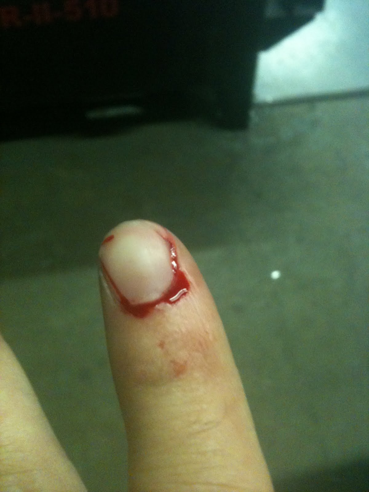 Cuticle Bleeding