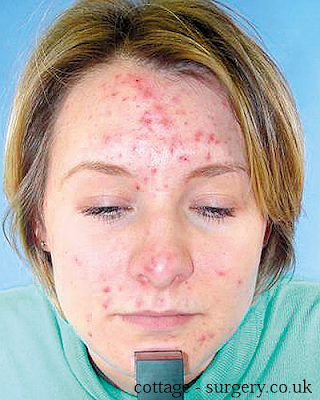 Rosacea is different than acne