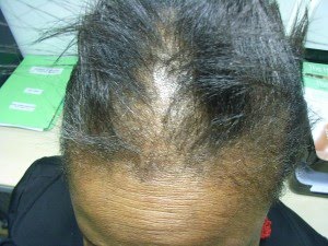 Biotin deficiency is