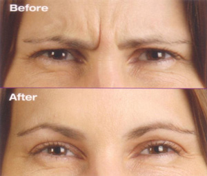 [botox.jpg]