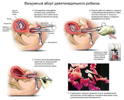 Выпадение волос у женщин лечение народными средствами в домашних