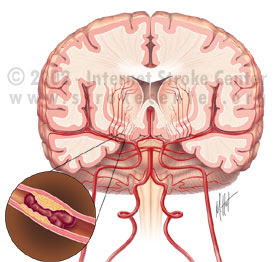 accidente vascular cerebral