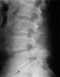 Espondilodistesis - La charnela lumbosacra