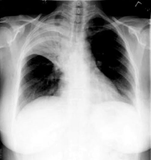 How to read a chest X Ray The easiest way to read a CXR Mezology...