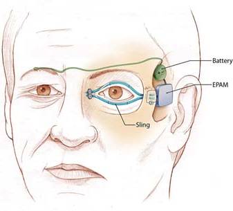 [musculo-pestañas.jpg]