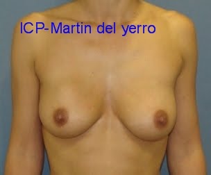 Un más pequeño pecho a la artista