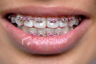 [ist2_2994002-dental-braces.jpg]