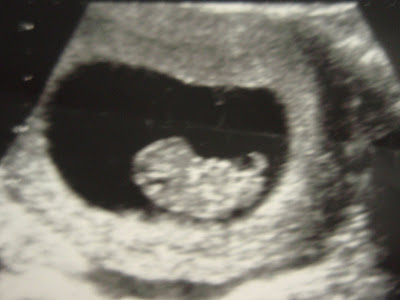 Scan Picturesweeks on My Baby Journey  Nine  9  Week Ultrasound