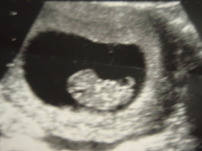 Scan Picturesweeks on My Baby Journey Nine 9 Week Ultrasound