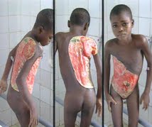 Mycobacterium ulcerans  infection