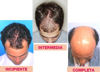 De la reconstitución de los cabello de la casa