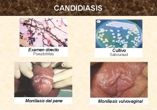 La medicina contra el hongo sobre la planta