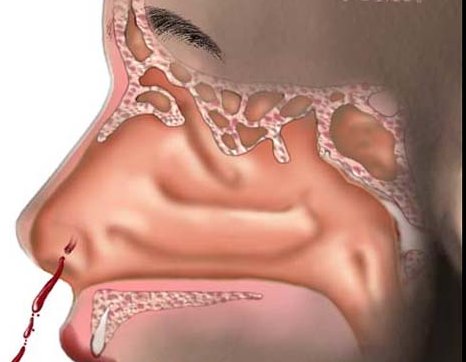 causas de la bulimia. causas de la bulimia. causas de la bulimia. Causas de la epistaxis; Causas; causas de la bulimia. Causas de la epistaxis; Causas de la epistaxis. titatom.