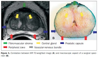 RadiologySpirit: MRI OF PROSTATE