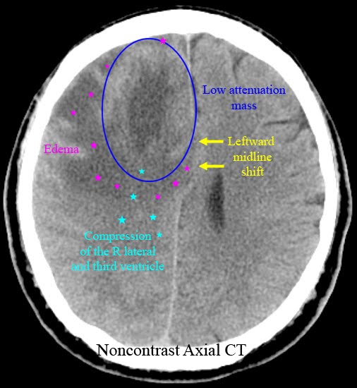 Ct+scan+brain+anatomy