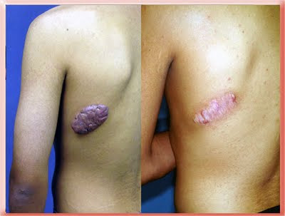 Keloid scar steroid injection before and after