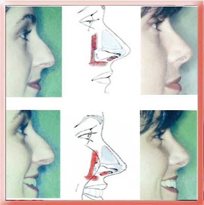 drooping nasal tip