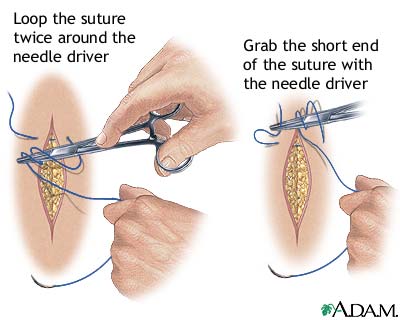 but I felt that suturing