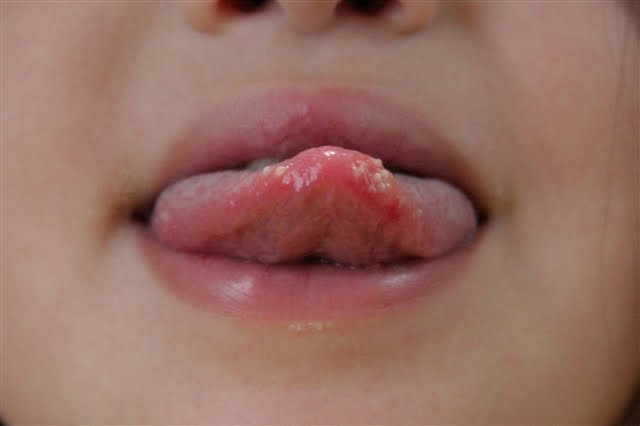 tongue blister pictures