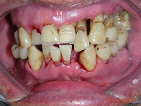 chronic periodontitis