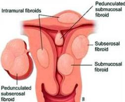 sore uterus