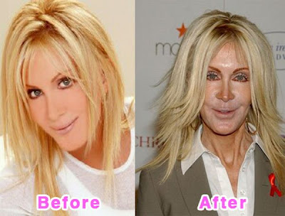 Celebrity Plastic Surgery Pictures on Chirurgie Esth  Tique Rat  E   Forum Dziriya Net