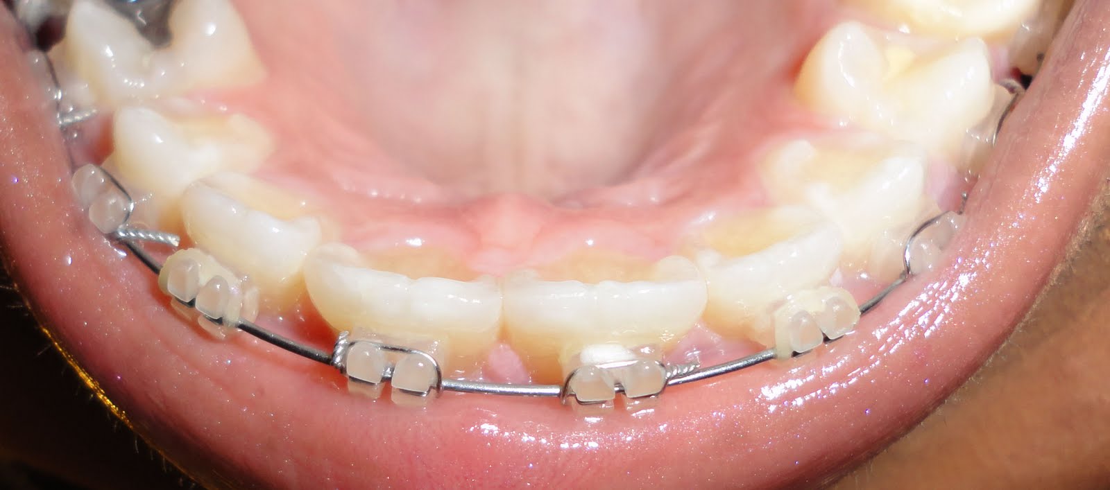 My Braces Experience