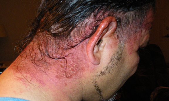 hair dye allergy health and nutrition