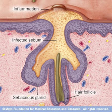 Acne Formation