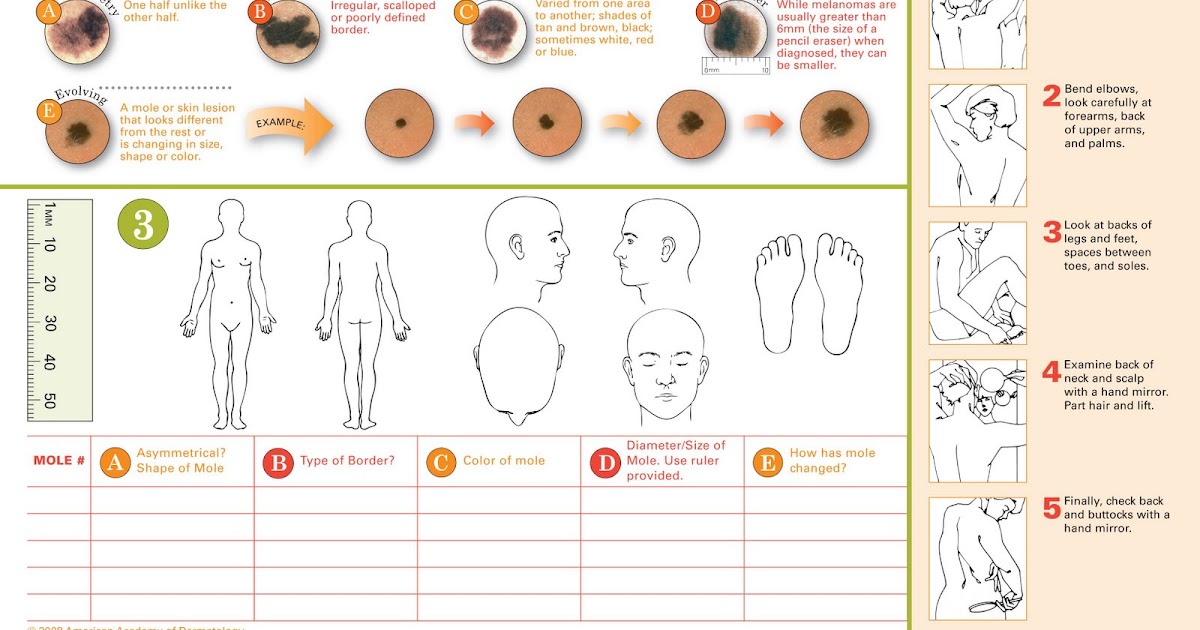 Sona MedSpa The Body Mole Map it may save your life!