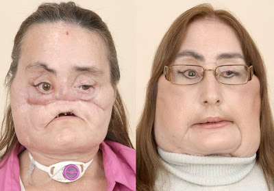 Connie Culp before and after the Face Transplant