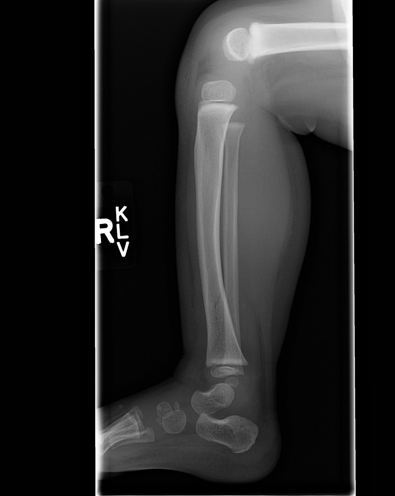 tibia fracture tibia fracture