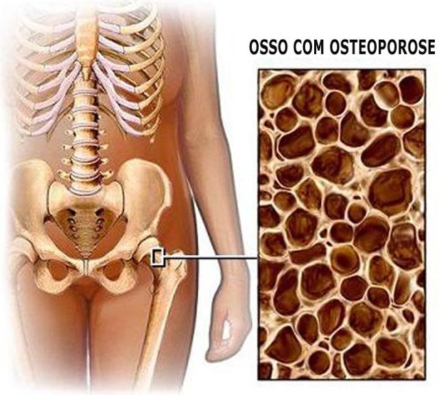 [osteoporose.bmp]