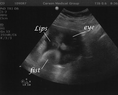 35 weeks (and an ultrasound!) ultrasounds at 6 weeks. 35 weeks (and an ultrasound!)