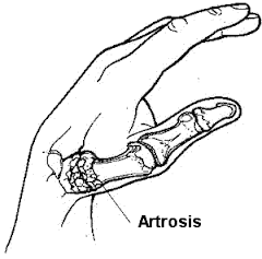 Artrosis del pulgar