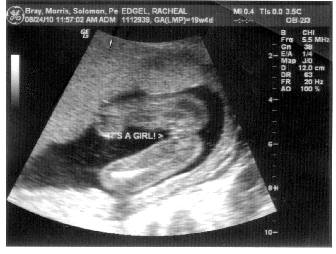 Baby Edgel 2: Anatomy Sonogram Visit - August 24th