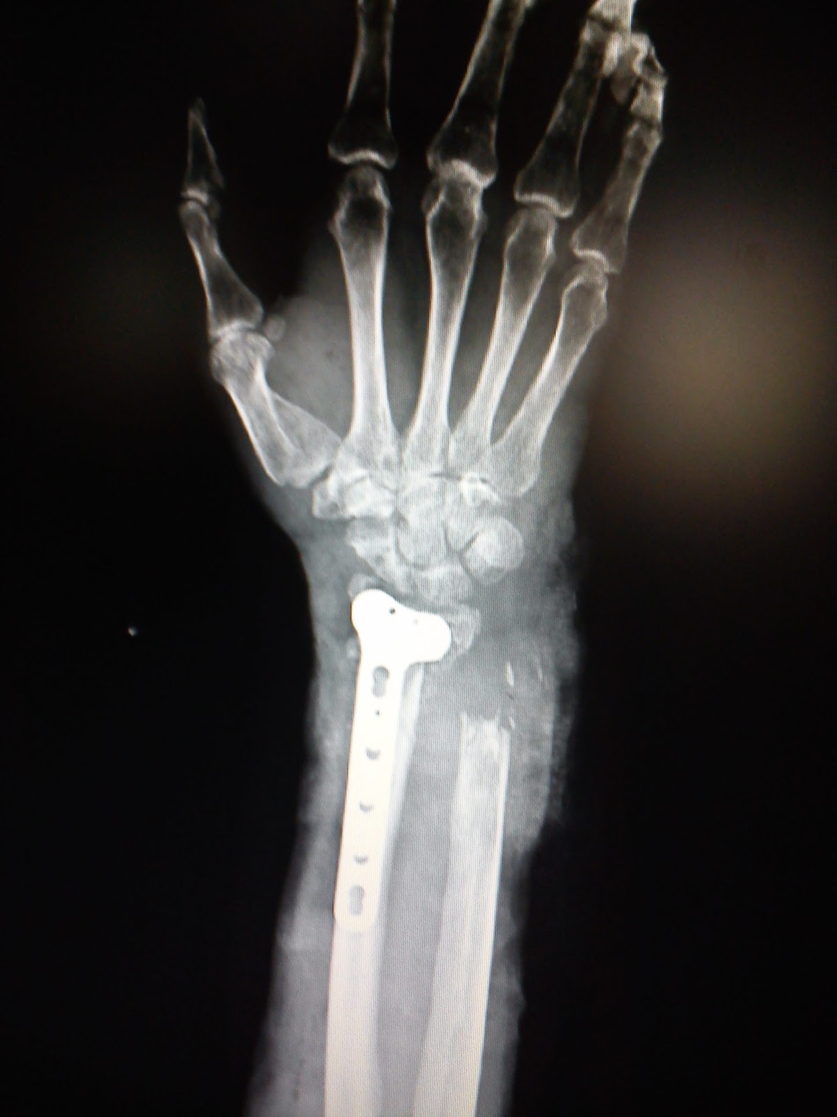 orthopaedics update Darrach's Procedure ,locking volar plate , bone graft