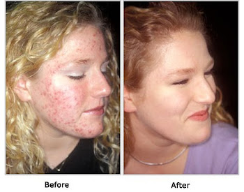 proactive before and after